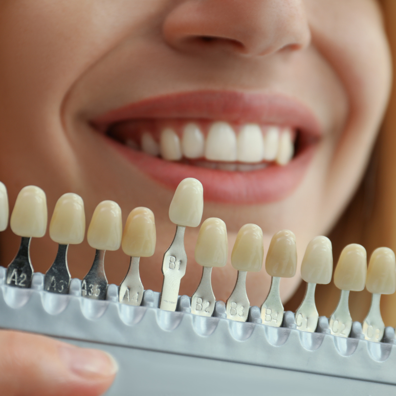 After Smile Design
