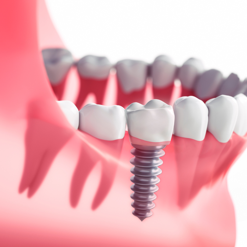 Dental Implants