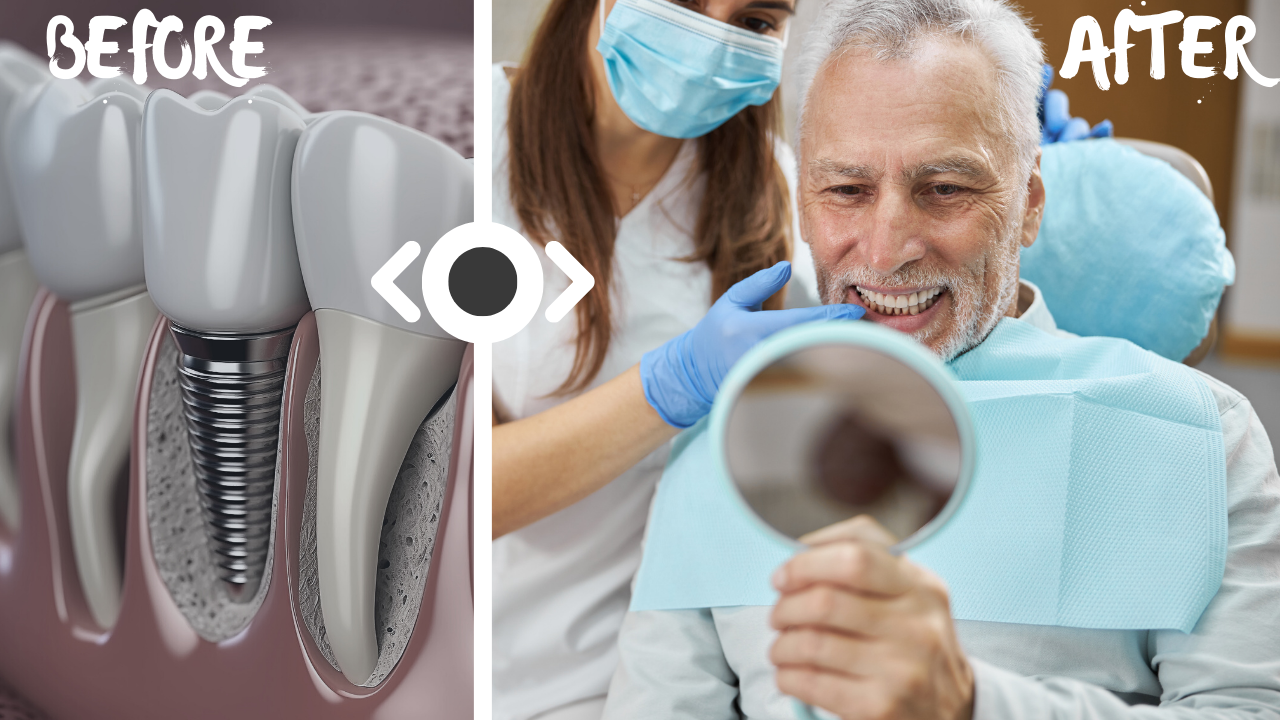 Dental Implant Procedure