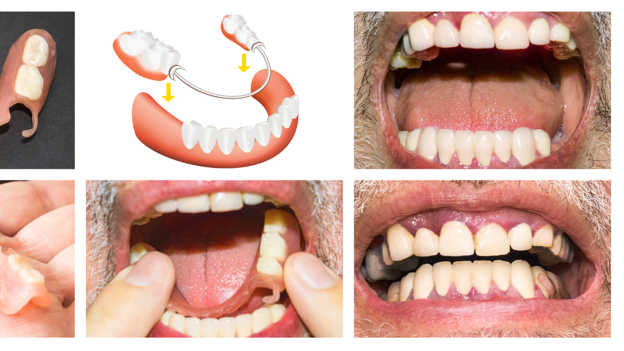 Full Mouth Rehabilitation